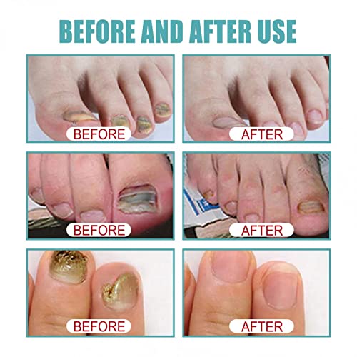 Средство за грижа за ноктите ZITIANY, ремонт на ноктите на краката, грижа за ноктите, за възстановяване на ноктите, Подхранва,