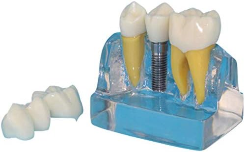 Модел на зъбен Имплант Модел на Човешкото Орален Зъб Прозрачен Модел на Зъба Обучение по Стоматология и Комуникацията с