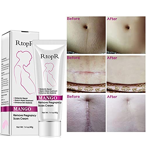 Reddhoon 2 Опаковки Манго Крем За Белези От стрии, Лечение на Стрии, Възстановяване за бременни, Възстановяване на Еластичността